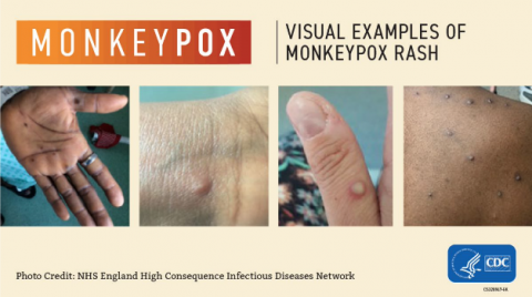 Monkeypox 101: Symptoms, Treatment, and Prevention